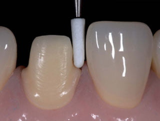 Why patients should choose all ceramic restorations instead of PFM (Porcelain fused to metal)